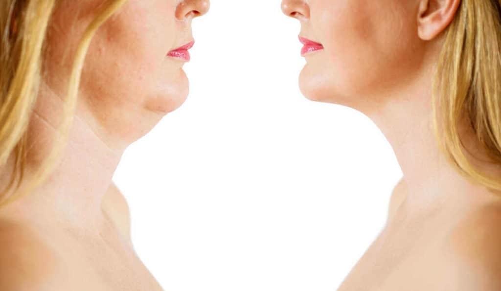 Double Chin treatment Bridgnorth before and after results