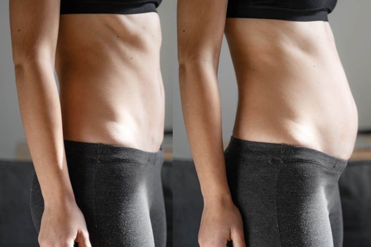 How long does diastasis recti take to improve Bridgnorth?