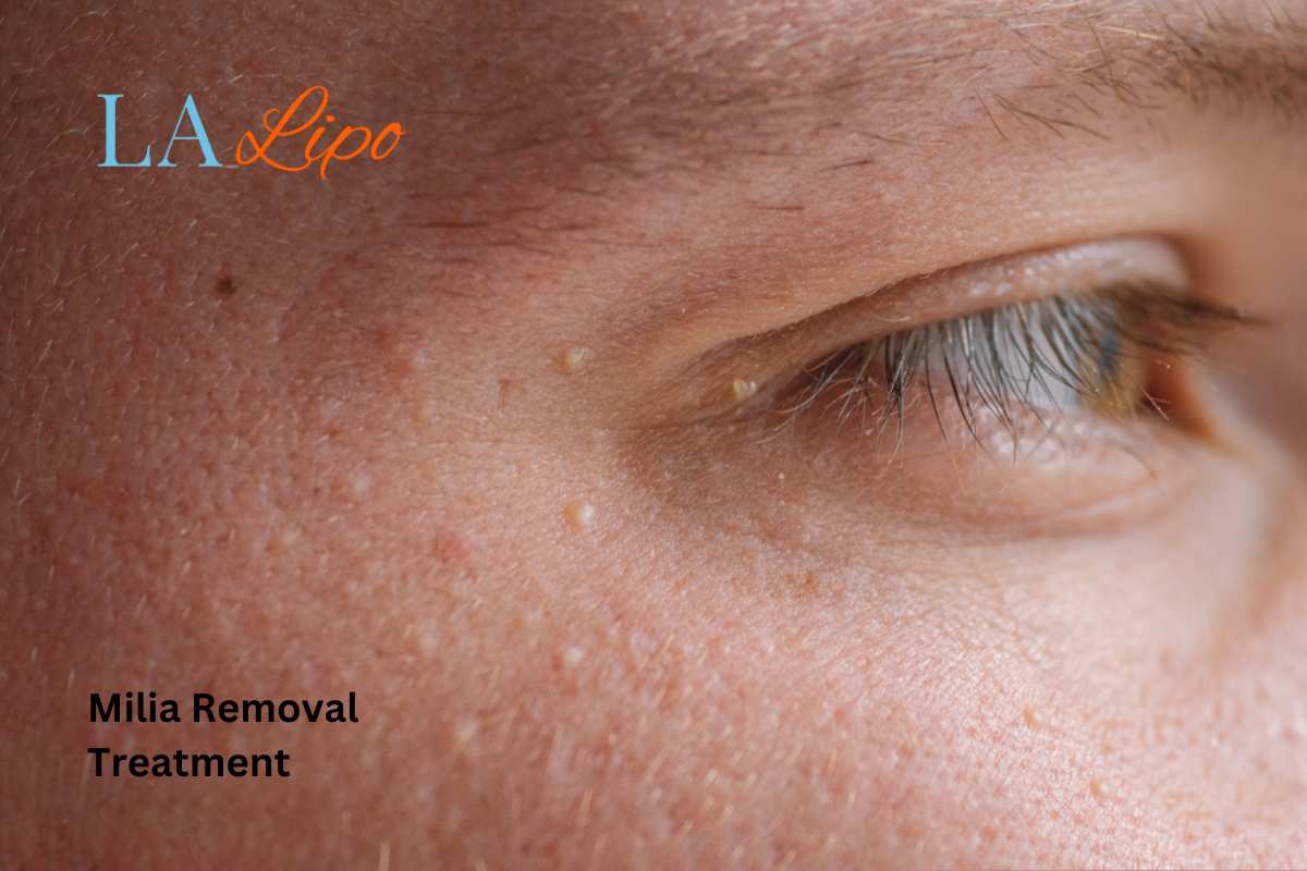 Cryopen Milia Removal: Is It the Easiest and Safest Option Bridgnorth?