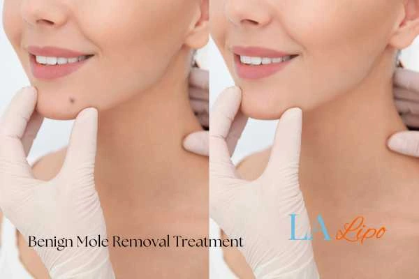 woman's before and after mole removal Bridgnorth results