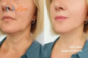 hi-fu for wrinkles Bridgnorth before and after results