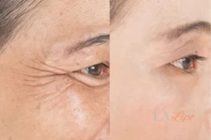 Before and after results of woman - HI-fu wrinkles reduction treatment Bridgnorth