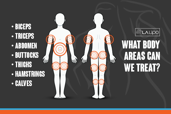 Graphic to show areas you can have LA-EMS Body Sculpting Bridgnorth treatment.