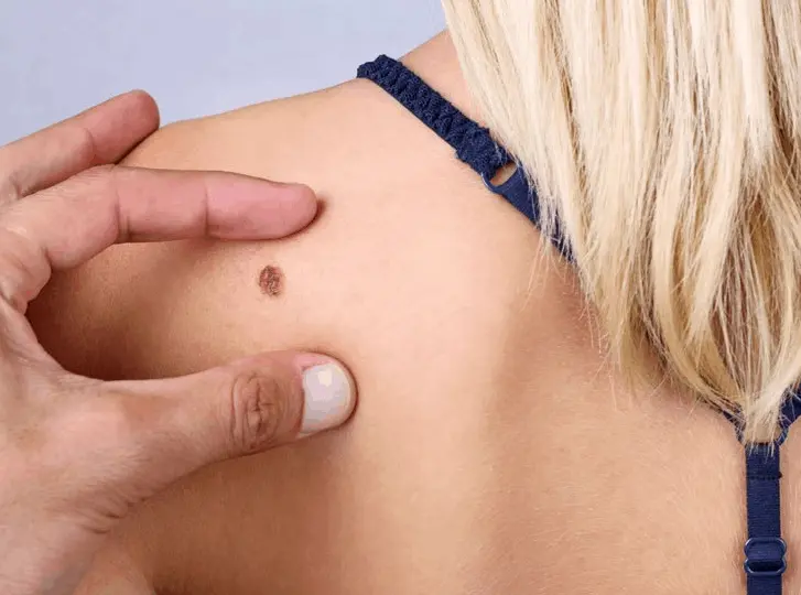 woman having mole removal Bridgnorth consultation before treatment.