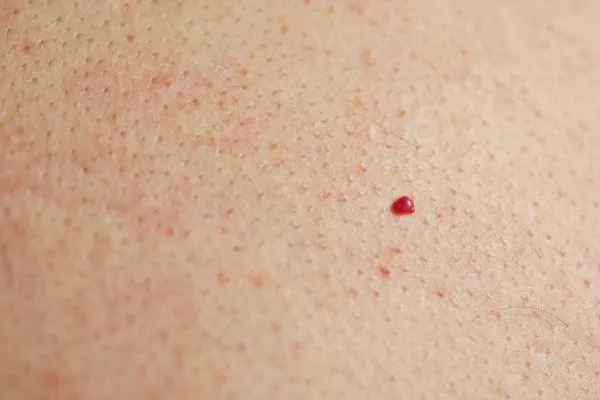 close up of a cherry angioma Bridgnorth