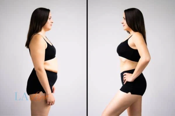 Picture of womans before and after using LA-EMS body sculpting to improve her core strength Bridgnorth