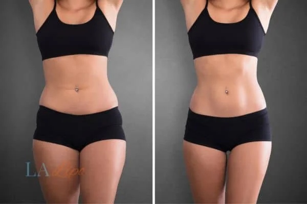 before and after results of non-surgical treatment to help a woman's body image and mental health Bridgnorth