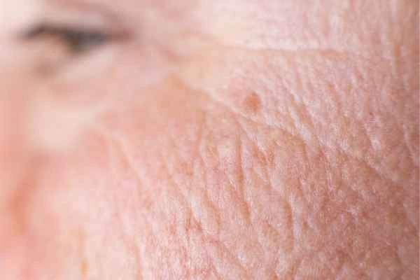 close up picture of a woman's face showing an age spot Bridgnorth