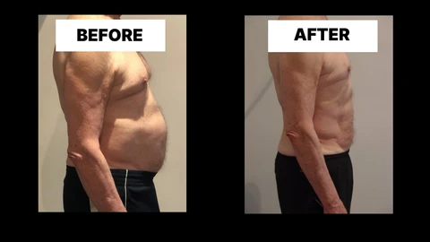 What Symptoms Can Diastasis Recti Cause in Men? Weak Core, Back Pain and Poor Posture Bridgnorth